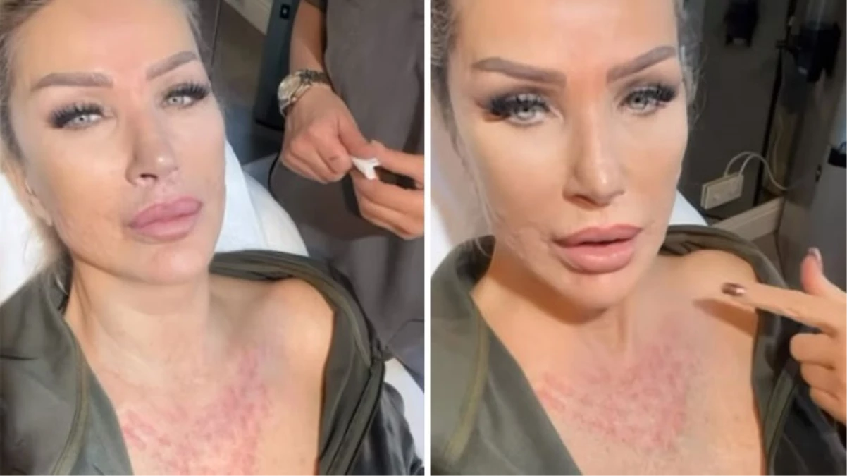 Seda Sayan, Sünnet Derisinden Elde Edilen Sıvıyı Yüzüne Enjekte Ettirdi