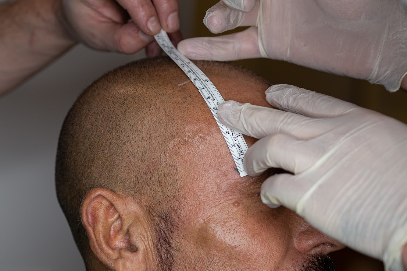 Clinista Saç Ekim Merkezi’nde Bireysel Tedavi Planları