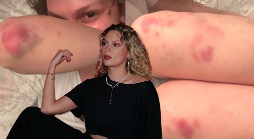 Farah Zeynep Abdullah’tan Korkutan Paylaşım! Morluklar İçindeki Halini Paylaştı