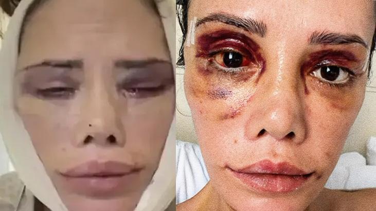 Yüz nakli olan Didem Ceran’dan sağlık paylaşımı: “Hızla iyileşiyorum”